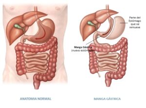 Manga Gástrica